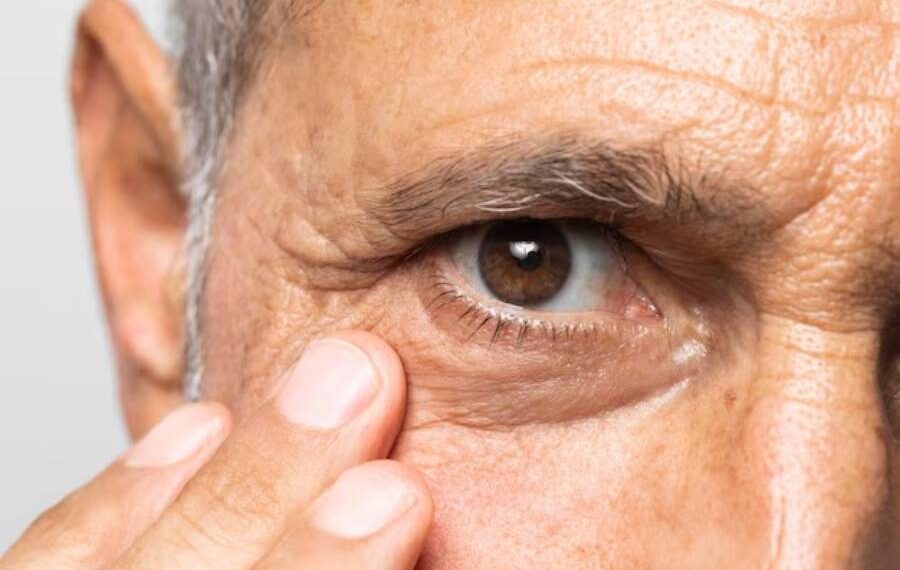 Glaucoma 70% dos indivíduos que sofrem com a doença não têm conhecimento do diagnóstico